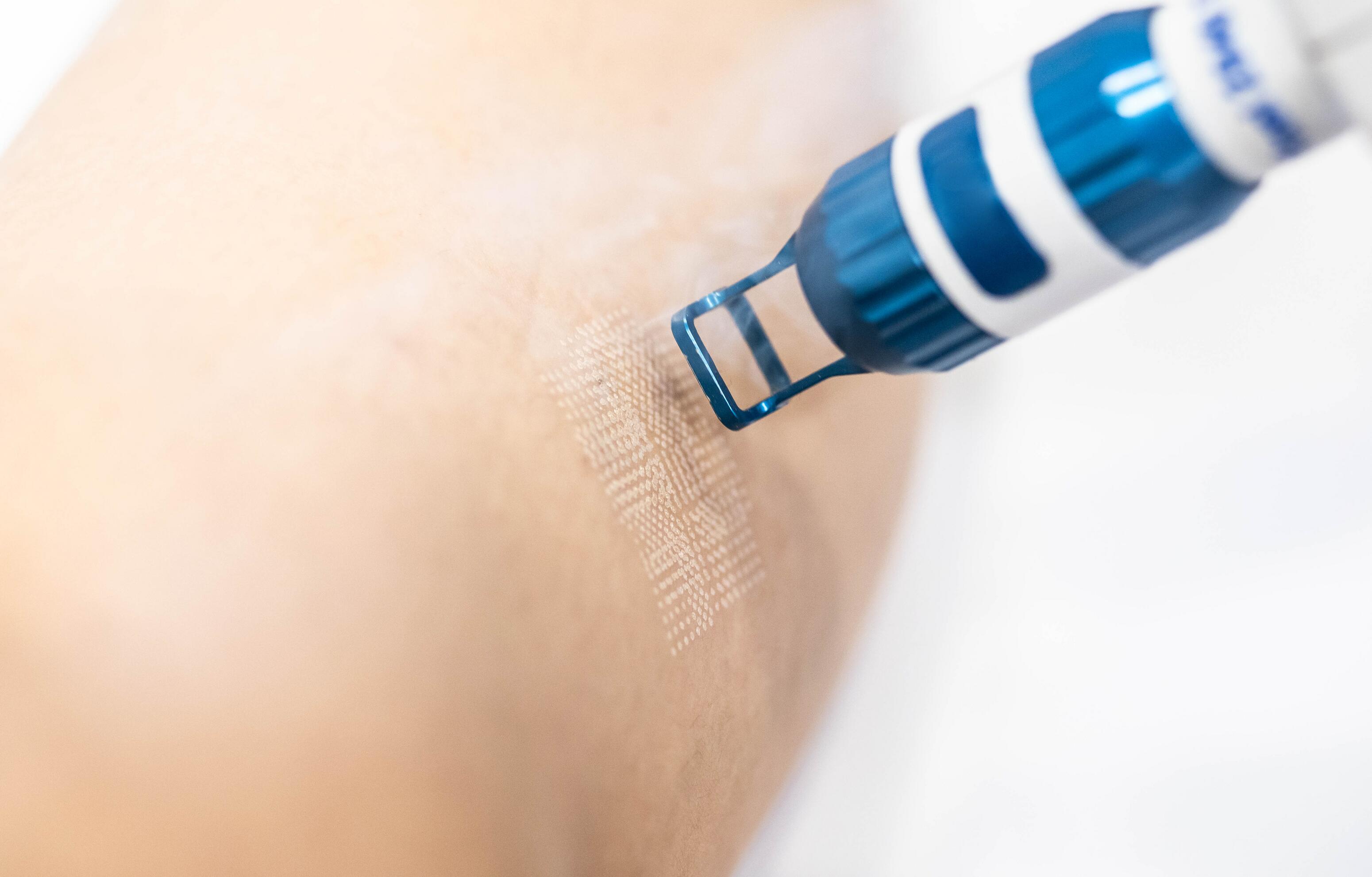 tratamiento con láser para reducir las cicatrices